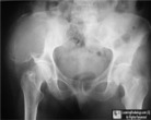 Renal Cell Carcinoma Metastasis